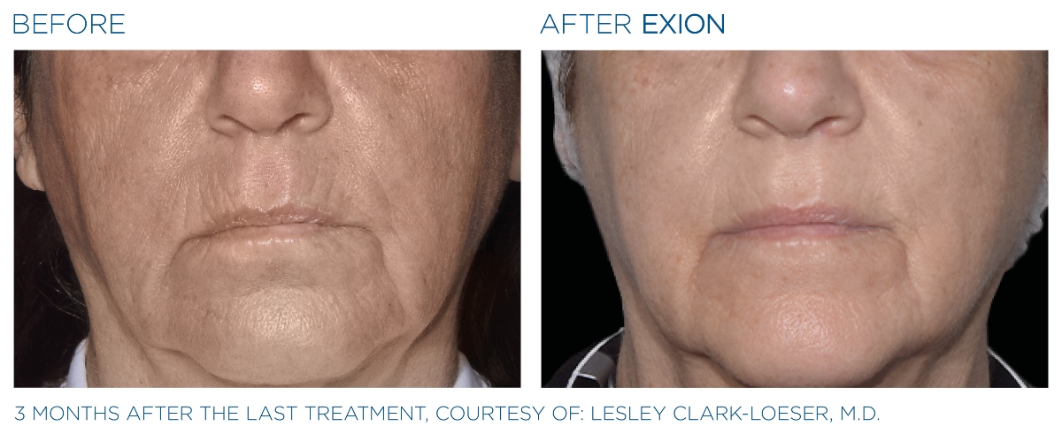 Exion Clear Mouth & Chin Before & After